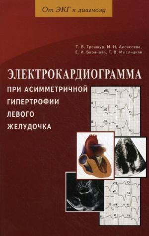 ЭКГ при асимметричной гипертрофии левого желудочка