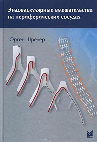 Эндоваскулярные вмешательства на периферических сосудах