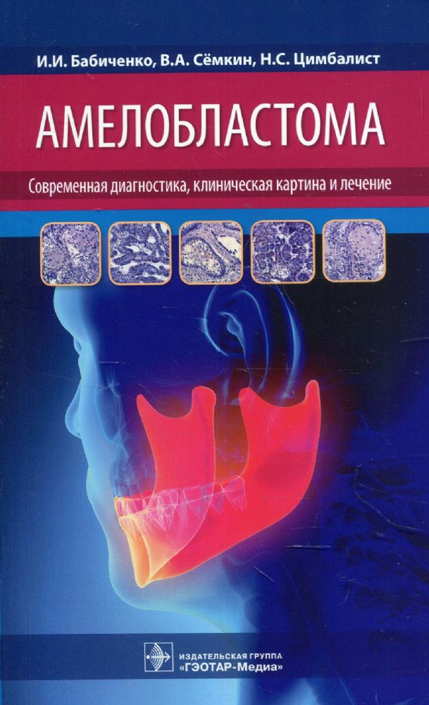 Амелобластома: современная диагностика, клиническая картина и лечение