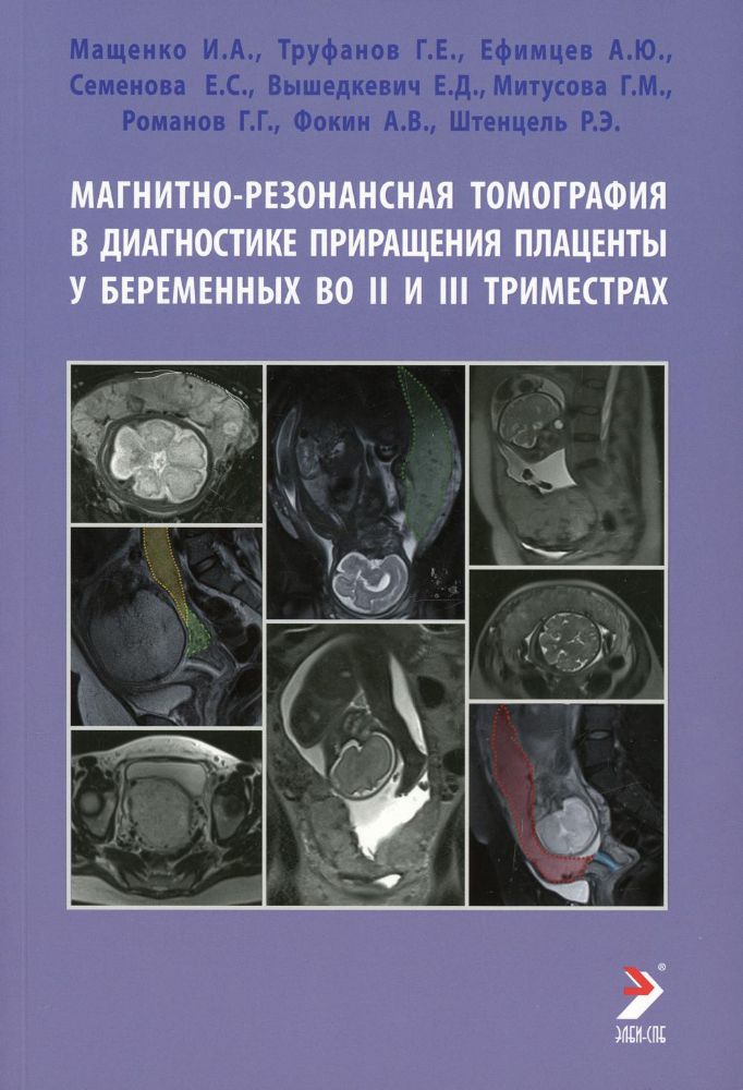 Магнитно-резонансная томография в диагностике приращения плаценты у беременных во II и III триместрах: Учебное пособие