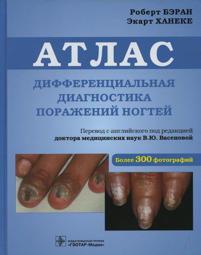 Дифференциальная диагностика поражений ногтей