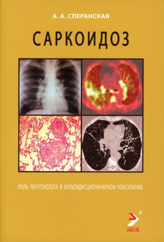 Саркоидоз. Роль ренгенолога в мультидисциплинарном консилиуме