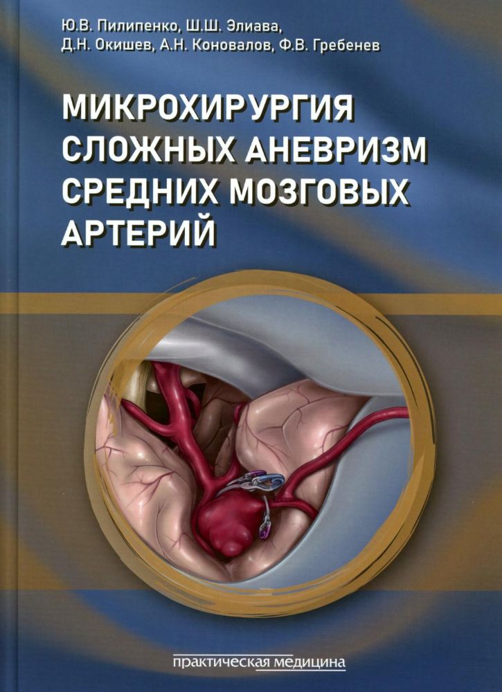 Микрохирургия сложных аневризм средних мозговых артерий: гигантских, фузиформных и частично тромбированных