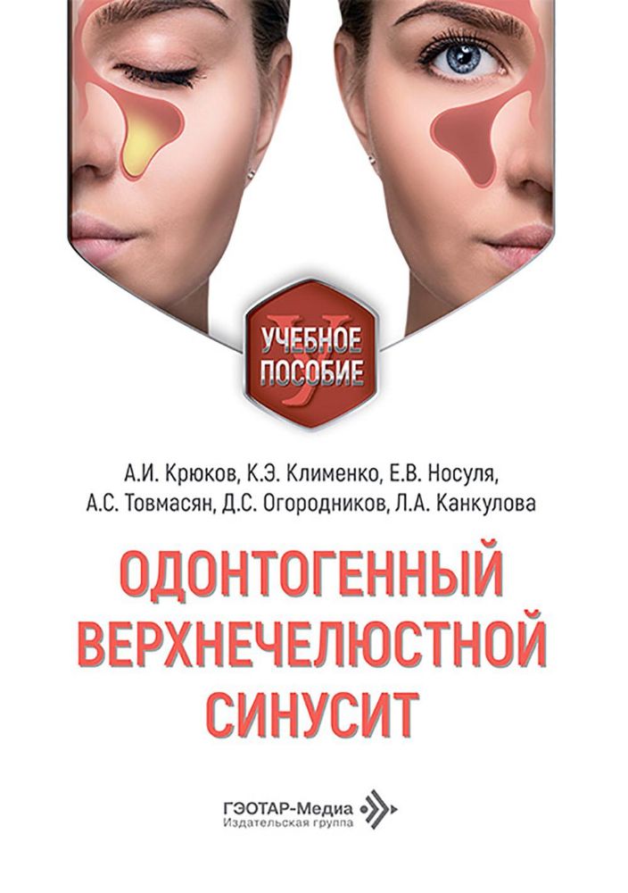 Одонтогенный верхнечелюстной синусит