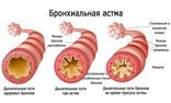 Бронхиальная астма